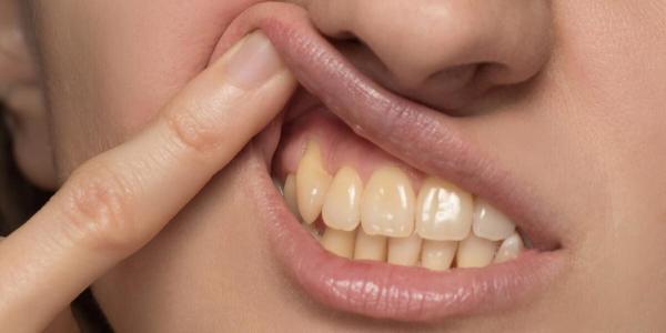 عادت های غلطی که دندان های شما را زرد می نماید