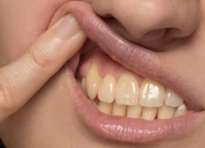 عادت های غلطی که دندان های شما را زرد می نماید